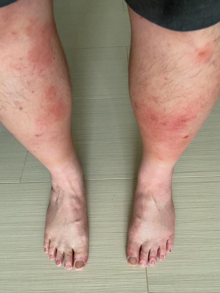 Skeeter Syndrome (allergic reaction to mosquito saliva) 